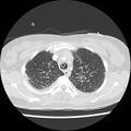 Acute pulmonary edema on CT (Radiopaedia 33582-34672 Axial lung window 10).jpg