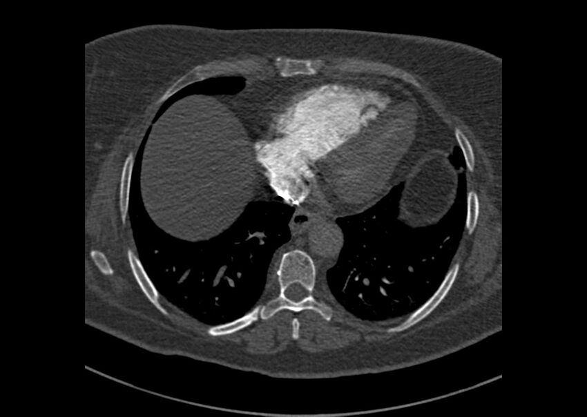 Acute pulmonary embolism (Radiopaedia 29938-30466 Axial C+ CTPA 168).jpg