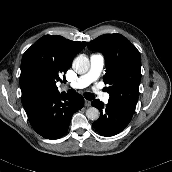 File:Acute pulmonary embolism (Radiopaedia 81677-95570 Axial C+ CTPA 38).jpg
