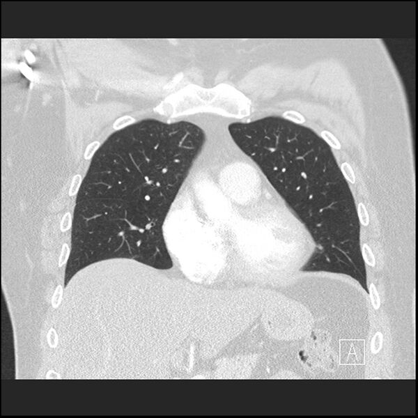 File:Acute pulmonary embolism with pulmonary infarct (Radiopaedia 73062-83768 Coronal lung window 26).jpg