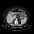 Acute pyelonephritis (Radiopaedia 25657-25837 Axial renal parenchymal phase 24).jpg