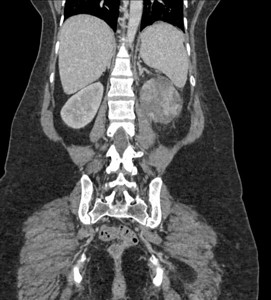 File:Acute pyelonephritis with renal vein thrombosis (Radiopaedia 58020-65053 Coronal renal parenchymal phase 87).jpg
