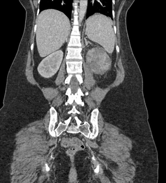 File:Acute pyelonephritis with renal vein thrombosis (Radiopaedia 58020-65053 Coronal renal parenchymal phase 89).jpg