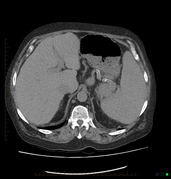 File:Acute renal failure post IV contrast injection- CT findings (Radiopaedia 47815-52557 Axial non-contrast 19).jpg