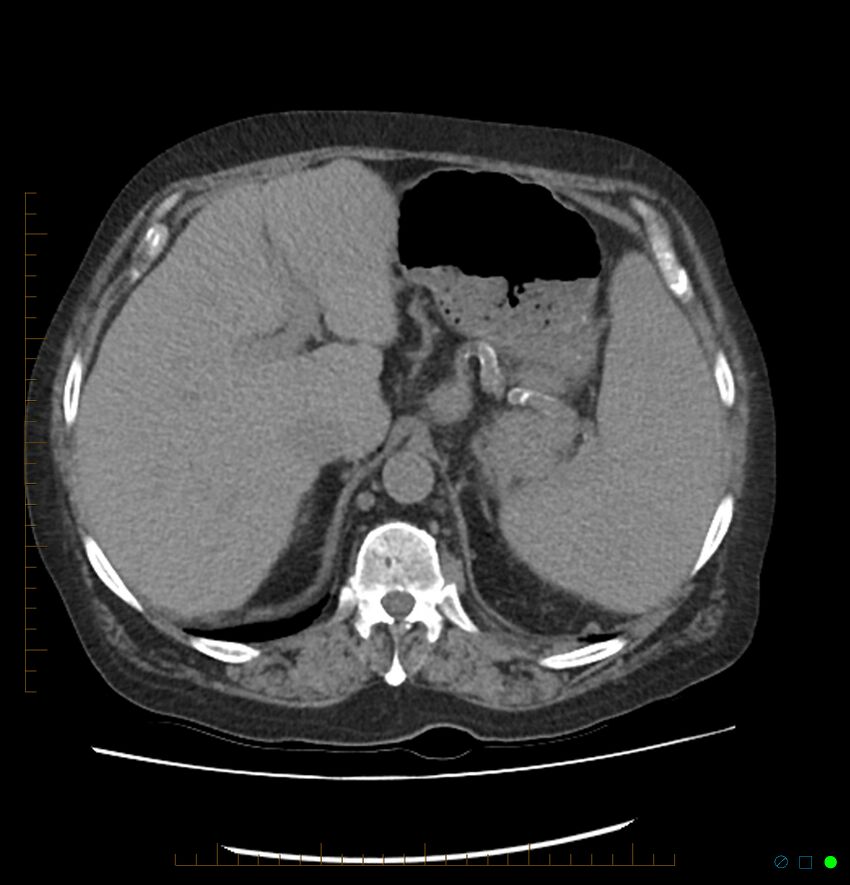 Acute renal failure post IV contrast injection- CT findings (Radiopaedia 47815-52557 Axial non-contrast 19).jpg