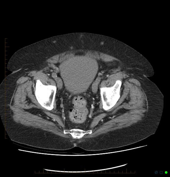 File:Acute renal failure post IV contrast injection- CT findings (Radiopaedia 47815-52557 Axial non-contrast 71).jpg