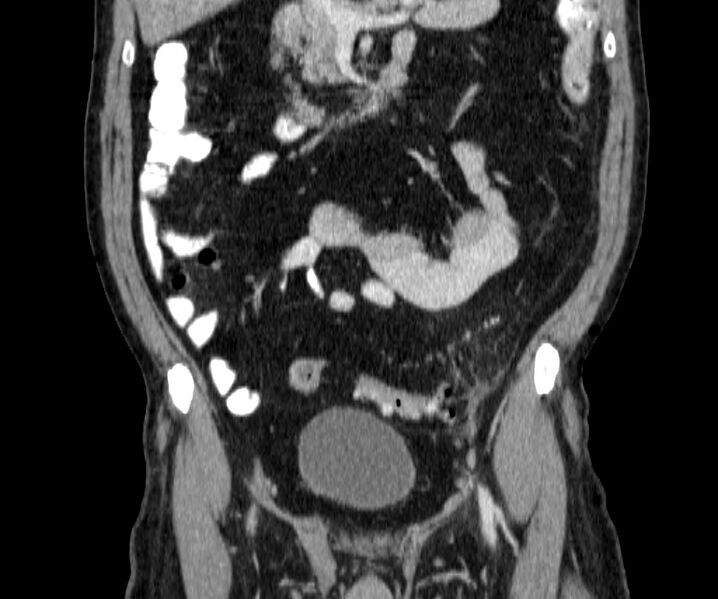 File:Acute sigmoid colon diverticulitis (Radiopaedia 55507-61976 Coronal C+ portal venous phase 56).jpg