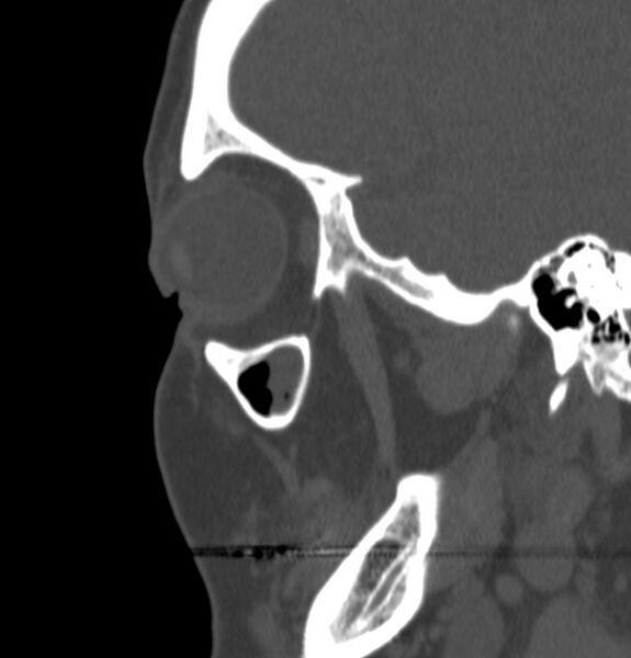 File:Acute sinusitis (Radiopaedia 22419-22455 Sagittal non-contrast 23).jpg