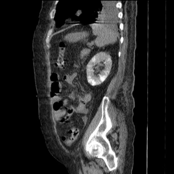 File:Acute tubular necrosis (Radiopaedia 28077-28334 H 65).jpg