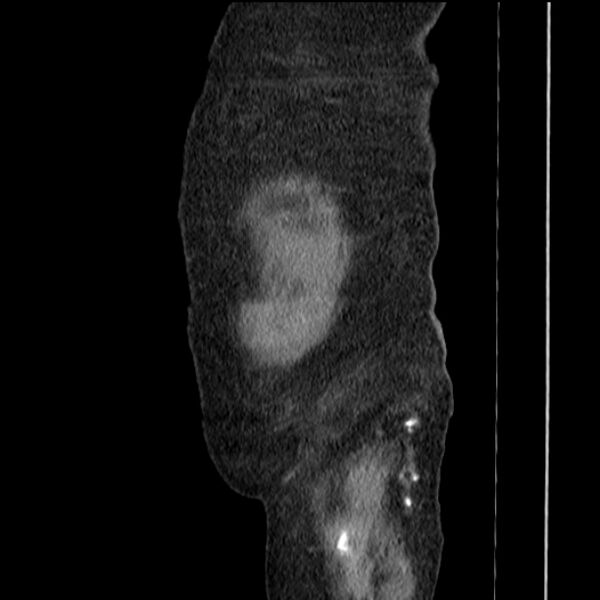 File:Acute tubular necrosis (Radiopaedia 28077-28334 H 82).jpg
