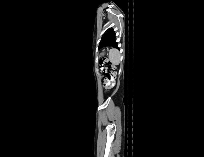 Addison disease (Radiopaedia 49318-54412 Sagittal C+ portal venous phase 7).jpg