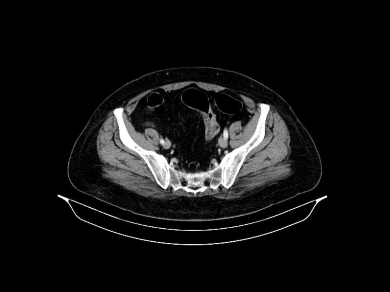File:Adenocarcinoma of pancreas with hepatic metastasis (Radiopaedia 64332-73122 Axial C+ portal venous phase 83).jpg
