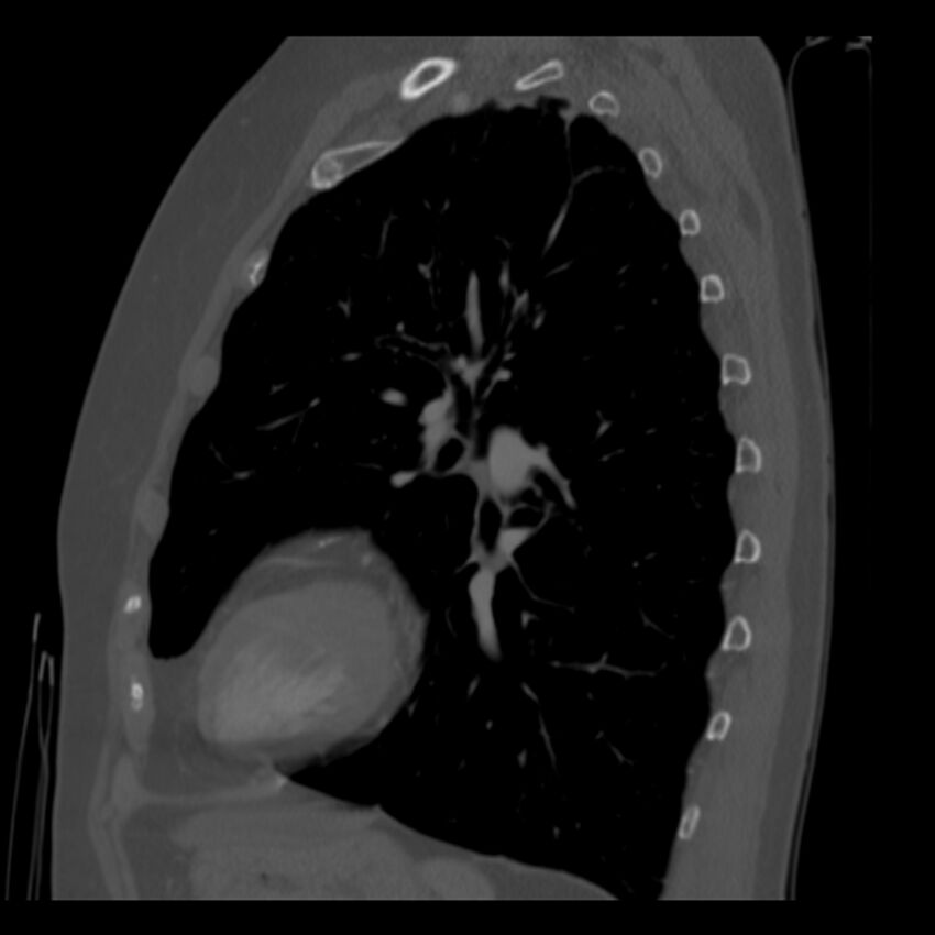 Adenocarcinoma of the lung (Radiopaedia 41015-43755 Sagittal bone window 72).jpg