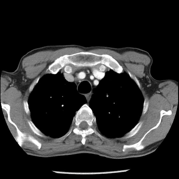 File:Adenocarcinoma of the lung - micropapillary predominant (Radiopaedia 42446-45563 Axial C+ portal venous phase 14).jpg