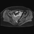 Adenomyosis and endometriotic cysts (Radiopaedia 82300-96367 Axial T1 C+ fat sat 20).jpg