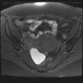 Adenomyosis and endometriotic cysts (Radiopaedia 82300-96367 Axial T1 fat sat 18).jpg