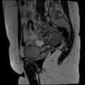 Adenomyosis and endometriotic cysts (Radiopaedia 82300-96367 Sagittal T2 26).jpg
