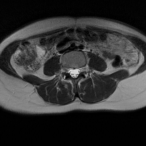 File:Adenomyosis within a septate uterus (Radiopaedia 69963-79981 Axial T2 2).jpg