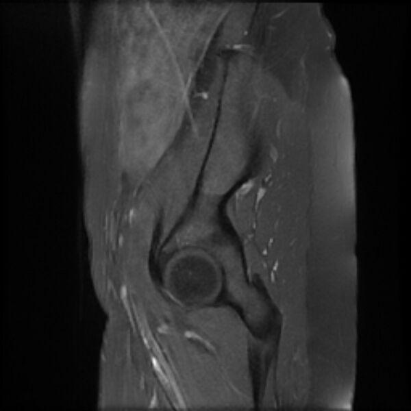 File:Adenomyosis within a septate uterus (Radiopaedia 69963-79981 Sagittal T1 fat sat 2).jpg