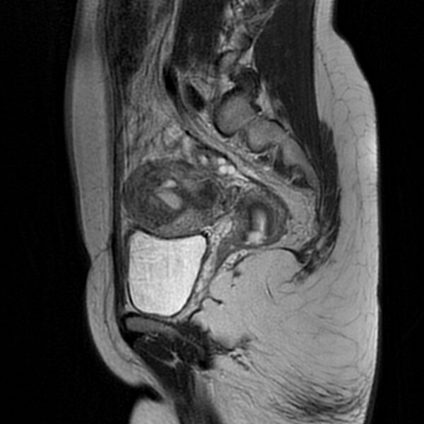 File:Adenomyosis within a septate uterus (Radiopaedia 69963-79981 Sagittal T2 20).jpg