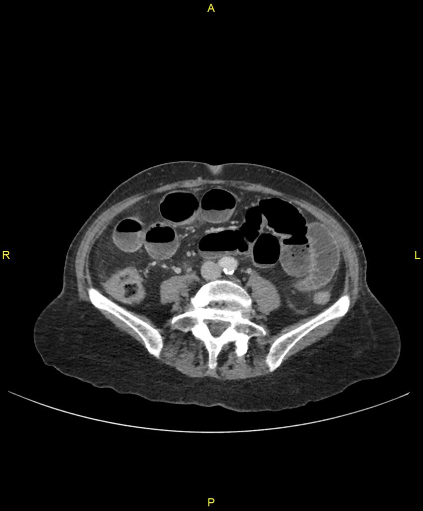 Adhesional small bowel obstruction (Radiopaedia 85402-101024 Axial C+ portal venous phase 174).jpg