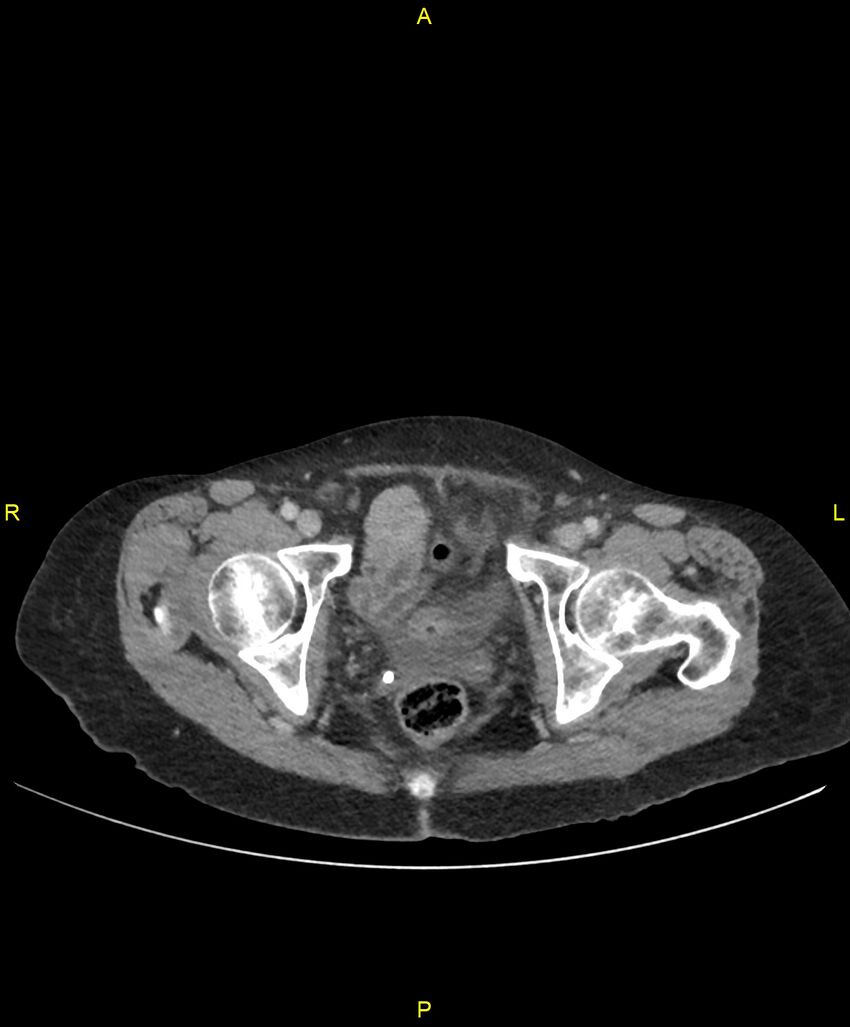 Adhesional small bowel obstruction (Radiopaedia 85402-101024 Axial C+ portal venous phase 275).jpg