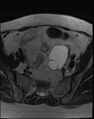 Adnexal multilocular cyst (O-RADS US 3- O-RADS MRI 3) (Radiopaedia 87426-103754 Axial T2 7).jpg