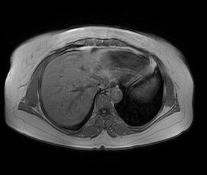 File:Adrenal cortical carcinoma (Radiopaedia 70906-81116 Axial T1 in-phase-out-of-phase 6).jpg