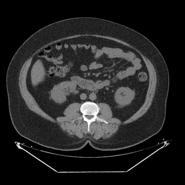 File:Adrenal myelolipoma (Radiopaedia 26278-26407 Axial non-contrast 35).jpg