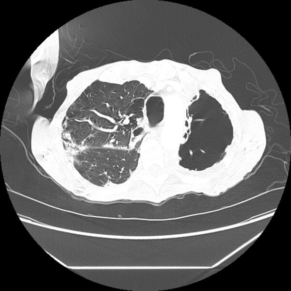 File:Advanced pulmonary tuberculosis (Radiopaedia 8599-9431 Axial lung window 14).jpg