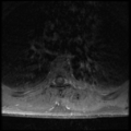 Aggressive vertebral hemangioma (Radiopaedia 39937-42404 Axial T1 C+ fat sat 22).png