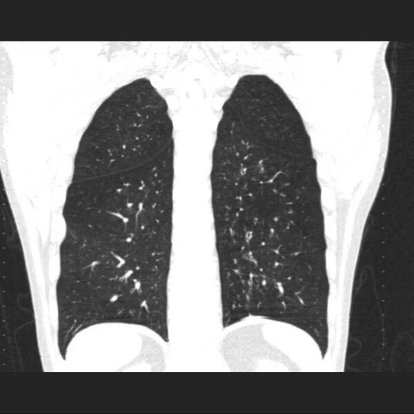 File:Allergic bronchopulmonary aspergillosis (Radiopaedia 21386-21320 Coronal lung window 14).jpg