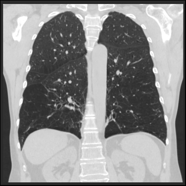 File:Alpha-1-antitrypsin deficiency (Radiopaedia 40993-43722 Coronal lung window 70).jpg