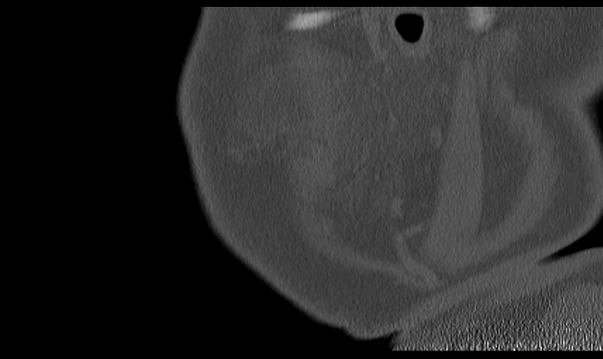 Ameloblastoma (Radiopaedia 33677-34806 Sagittal bone window 10).png