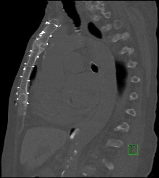 File:Amiodarone deposition in the liver (Radiopaedia 77587-89780 Sagittal bone window 46).jpg