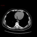 Ampullary carcinoma (Radiopaedia 56396-63056 Axial non-contrast 4).jpg
