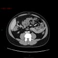 Ampullary carcinoma (Radiopaedia 56396-63056 C 57).jpg