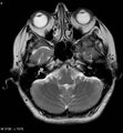 Amyotrophic lateral sclerosis (Radiopaedia 5373-7134 Axial T2 6).jpg