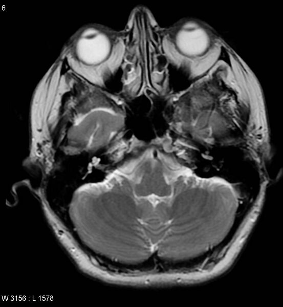 File:Amyotrophic lateral sclerosis (Radiopaedia 5373-7134 Axial T2 6).jpg