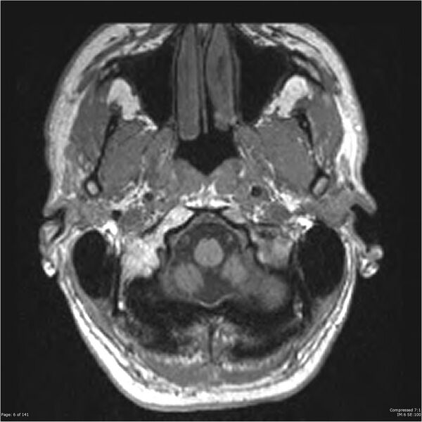 File:Anaplastic meningioma with recurrence (Radiopaedia 34452-35788 Axial T1 4).jpg