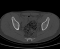 Aneurysmal bone cyst of ischium (Radiopaedia 25957-26094 Axial bone window 44).png