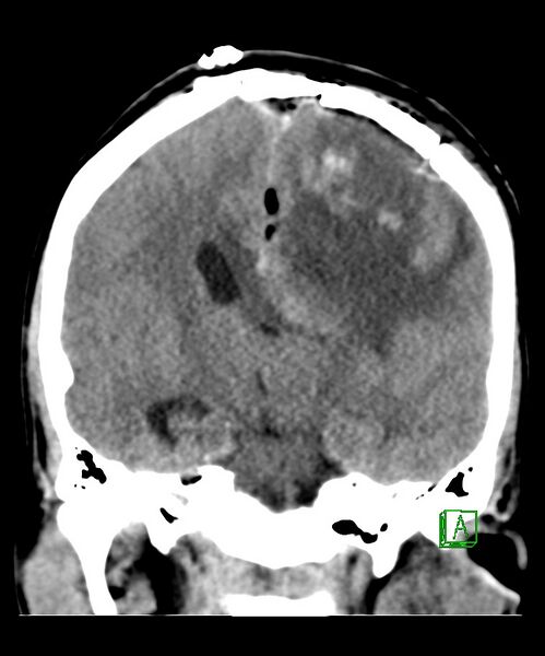 File:Angiomatous meningioma (Radiopaedia 79459-92578 Coronal non-contrast 20).jpg