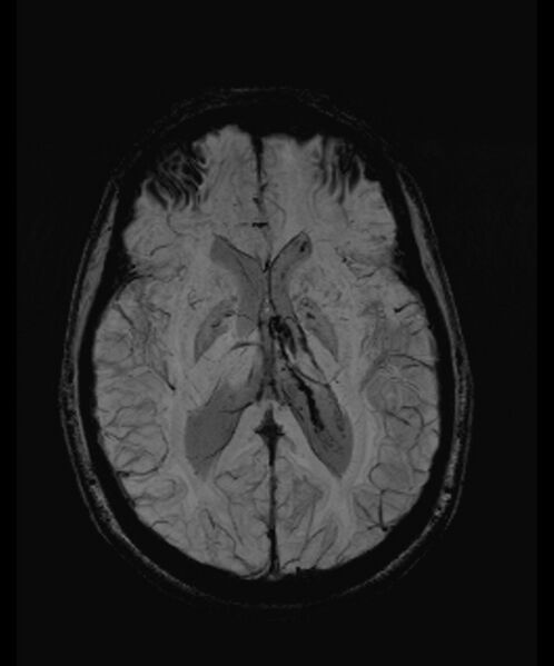 File:Angiomatous meningioma (Radiopaedia 79459-92579 E 35).jpg