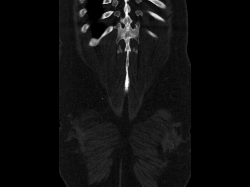 File:Ankylosing spondylitis (Radiopaedia 44609-48357 Coronal bone window 100).jpg