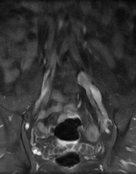 File:Ankylosing spondylitis - Andersson lesion (Radiopaedia 81878-95838 H 2).jpg