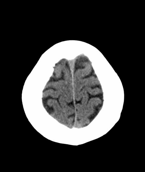 File:Anomalous intracranial venous drainage (Radiopaedia 28161-28418 Axial 54).png