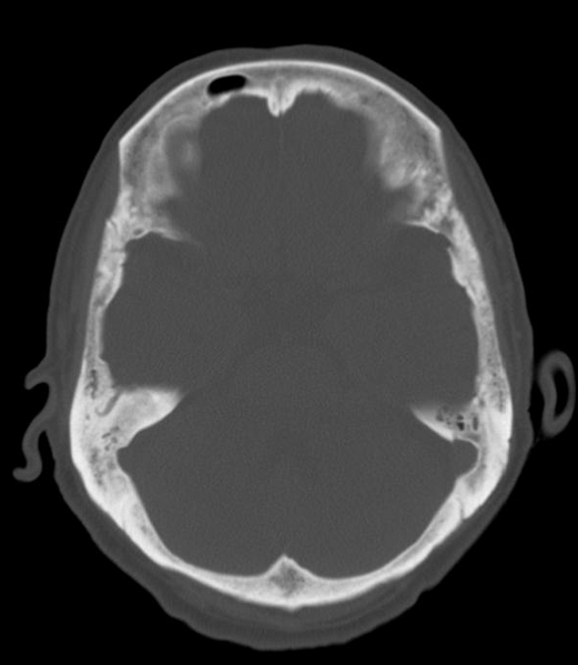 File:Anomalous intracranial venous drainage (Radiopaedia 28161-28418 Axial 6).png