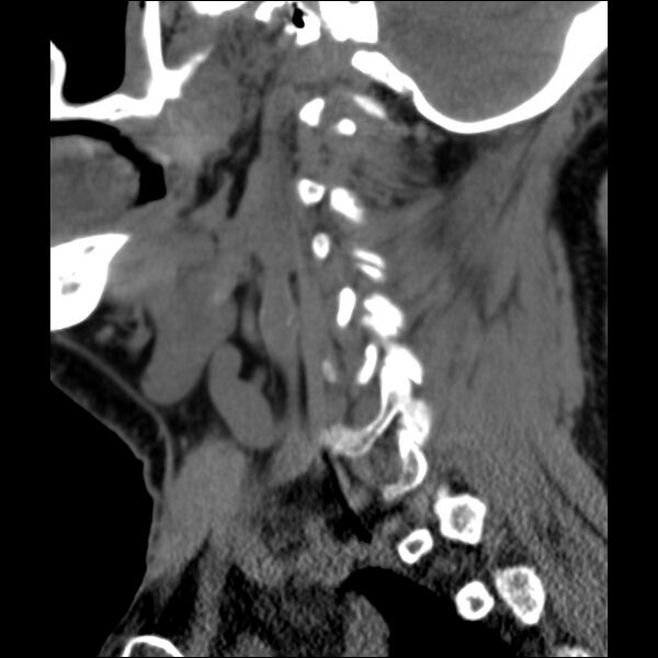 File:Anterior cervical postdiscectomy arthrodesis (Radiopaedia 32678-33646 C 35).jpg