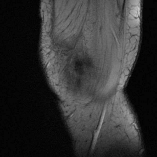 File:Anterior cruciate ligament tear - ramp lesion (Radiopaedia 71883-82322 Sagittal T2 fat sat 24).jpg