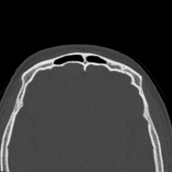 File:Antrochoanal polyp (Radiopaedia 21894-21868 Axial bone window 44).jpg